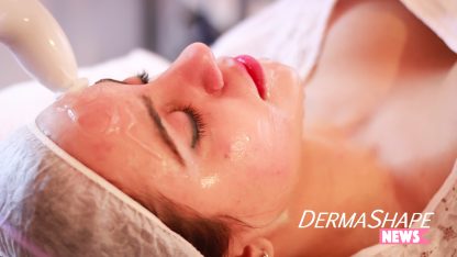 Luz Pulsada IPL para manchas faciales y rosacea - Imagen 2