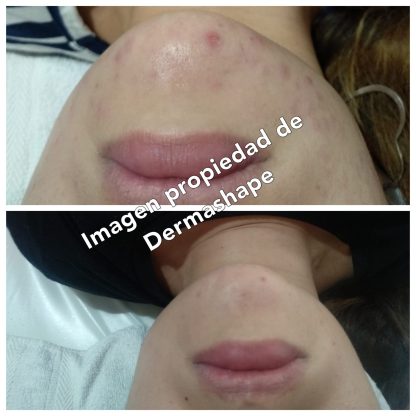 Limpieza facial con extracciones de puntos negros - Imagen 3