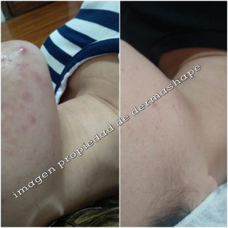 Acné, Brotes y Granos