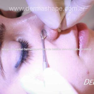 Limpieza facial con extracciones de puntos negros