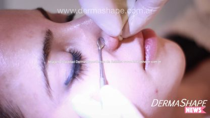Limpieza facial con extracciones de puntos negros