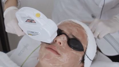 Luz Pulsada IPL para manchas faciales y rosacea - Imagen 3